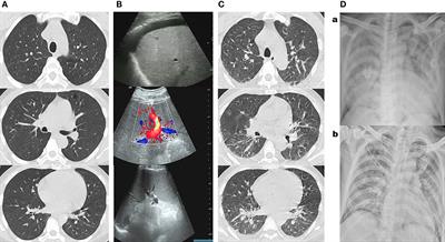 Disseminated Human Parvovirus B19 Infection Induced Multiple Organ Dysfunction Syndrome in an Adult Patient With Alcoholic Hepatitis Complicated by Hemolytic Anemia: A Case Report and Literature Review